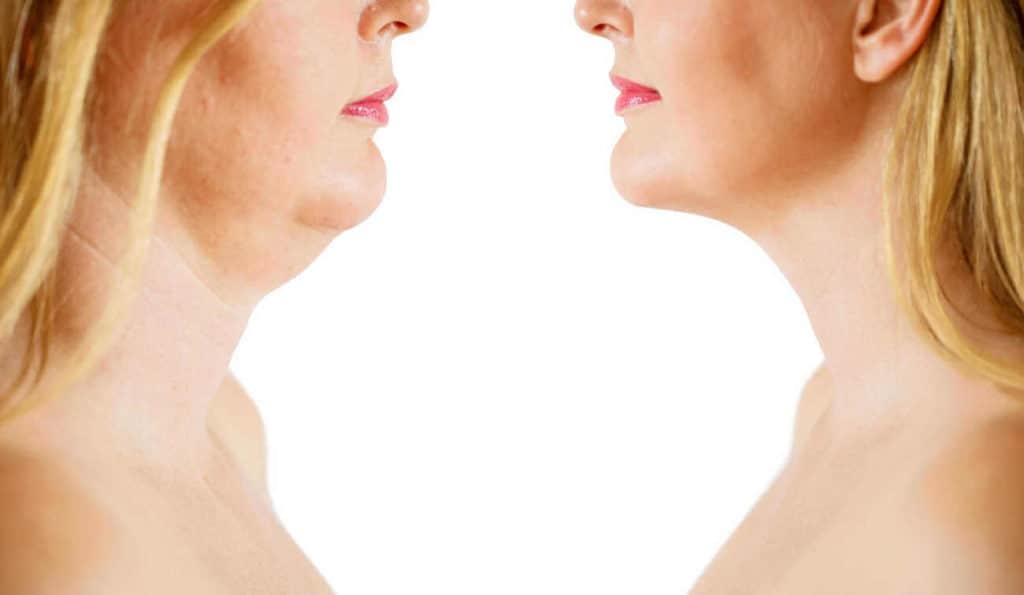 Double Chin treatment Portsmouth before and after results