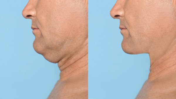 Which Non-Surgical Treatments Work Best for Jowls and Loose Skin Portsmouth?
