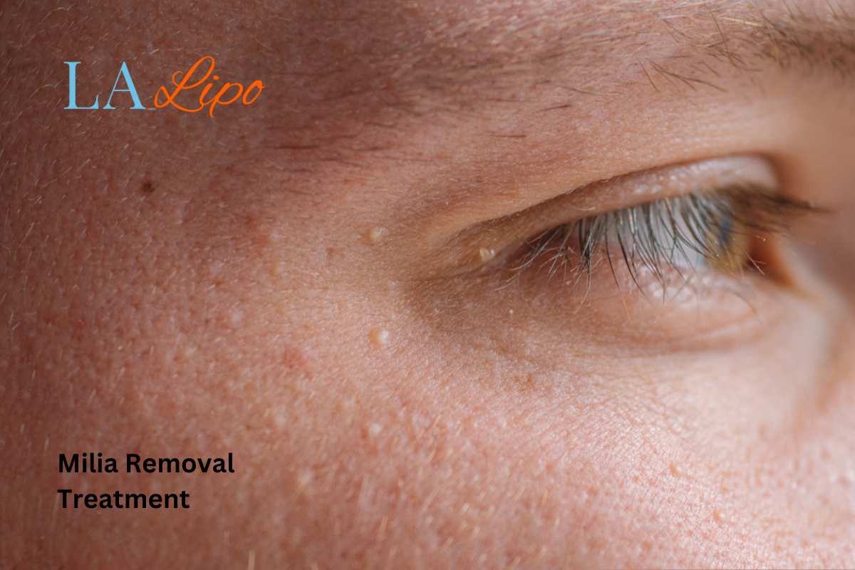 Cryopen Milia Removal: Is It the Easiest and Safest Option Portsmouth?