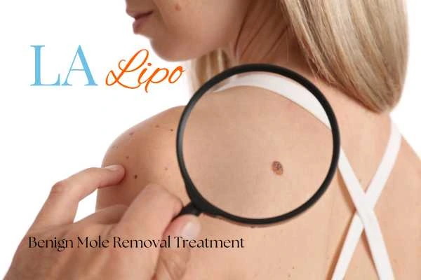Why getting moles removed Portsmouth can boost your confidence!