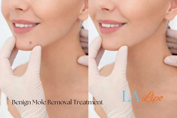 woman's before and after mole removal Portsmouth results