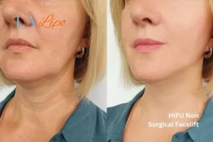 hi-fu for wrinkles Portsmouth before and after results