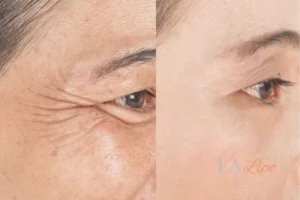Before and after results of woman - HI-fu wrinkles reduction treatment Portsmouth
