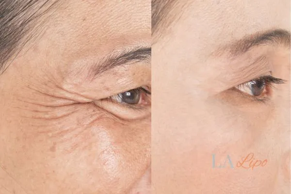 Before and after results of woman - HI-fu wrinkles reduction treatment Portsmouth