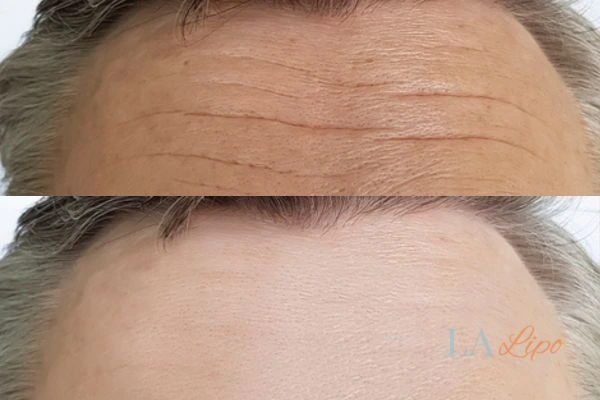 results of HIFU Portsmouth on mans forehead to help reduce lines and wrinkles