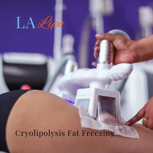 fat freezing - Cryolipolysis Portsmouth