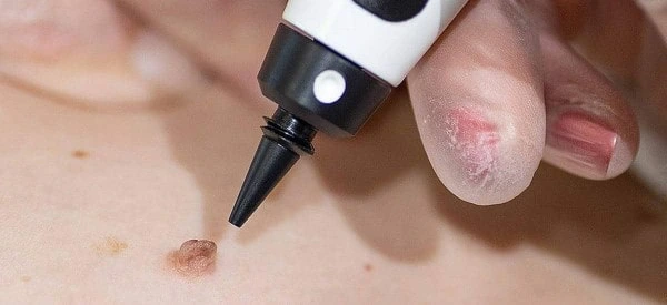 skin tag removal using cryopen Portsmouth