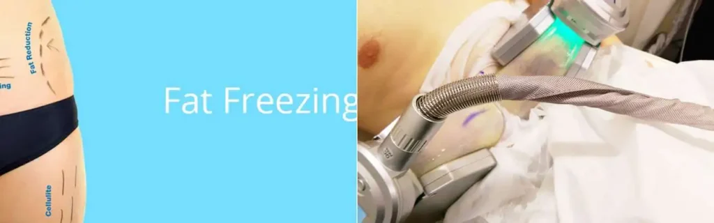 multi areas of a persons body having coolsculpting Portsmouth treatment
