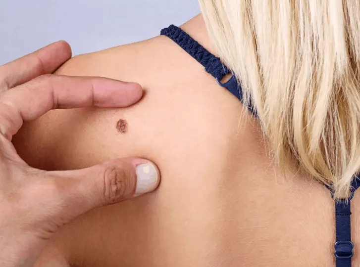 woman having mole removal Portsmouth consultation before treatment.