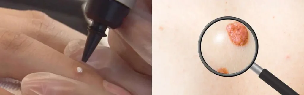 Cryopen for mole removal Portsmouth - speak to our team today!