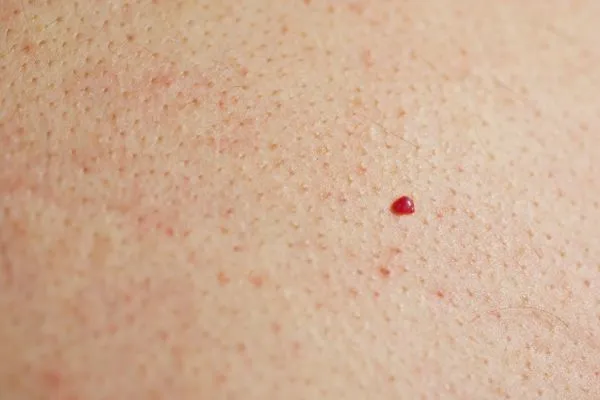close up of a cherry angioma Portsmouth