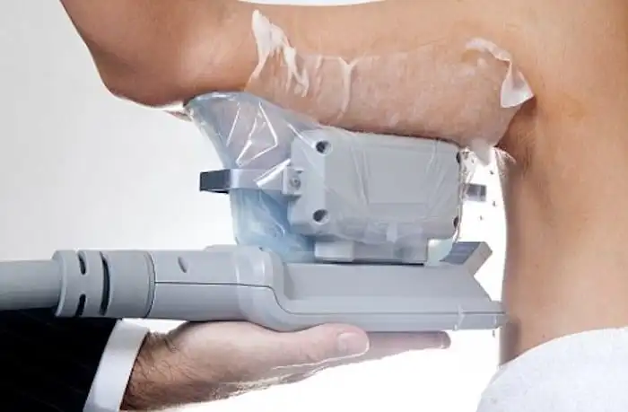 Picture of fat freezing Portsmouth on the upper arms.