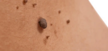 image of a skin tag Portsmouth