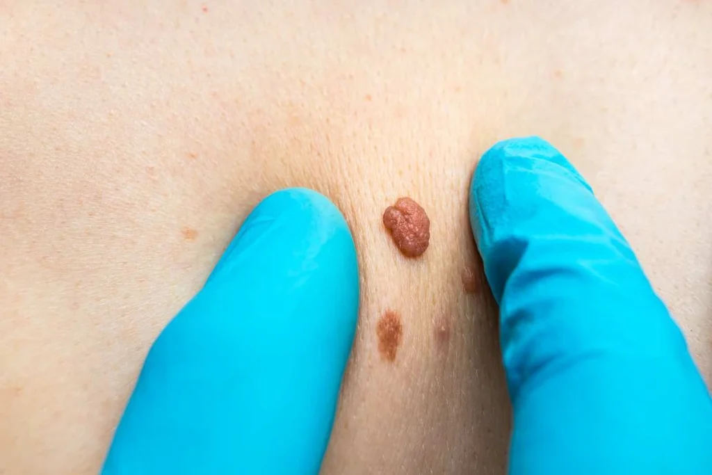 Consultant examining a skin tag Portsmouth