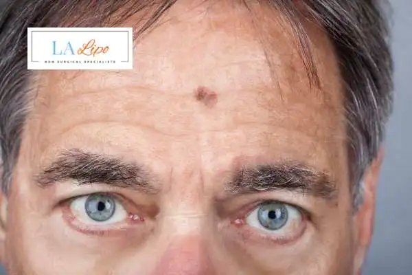 Solar Lentigo Removal Portsmouth image of man with mark on his forehead