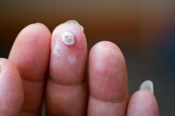 wart on person finger - cryotherapy to treat from LA LIPO Portsmouth
