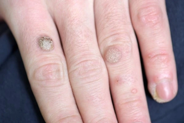 photo of warts on person hand - see wart removal Portsmouth from LA LIPO