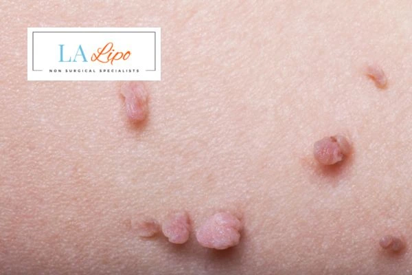 Does cryopen skin tag removal Portsmouth hurt? Find out now call our team today!