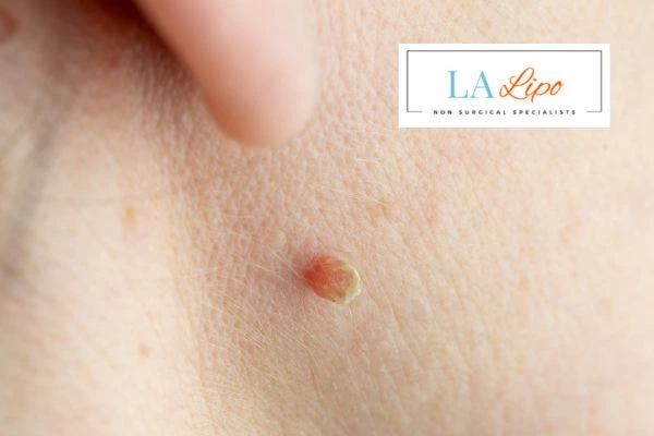 Book skin tag removal Portsmouth today speak to our team now!