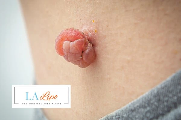 Interested in skin tag removal Portsmouth? Concerned about the pain? Find out more today!