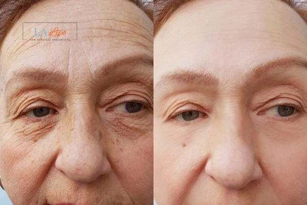 The powerful benefits of Morpheus8 Treatment Portsmouth - Call Our team today!