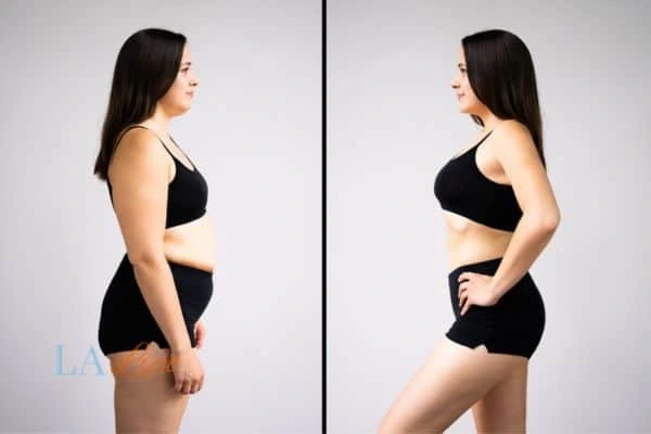 Picture of womans before and after using LA-EMS body sculpting to improve her core strength Portsmouth