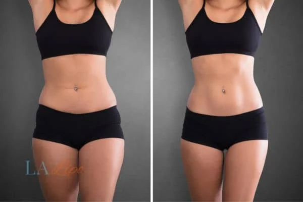 before and after results of non-surgical treatment to help a woman's body image and mental health Portsmouth