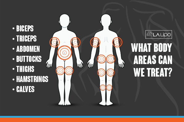 Diagram to show areas you can have LA-EMS Body Sculpting Treatment Portsmouth