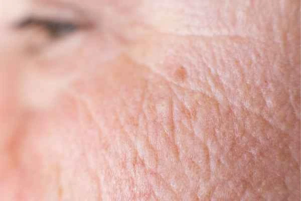close up picture of a woman's face showing an age spot Portsmouth