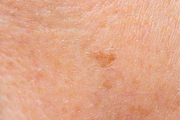 close up picture of age spots Portsmouth