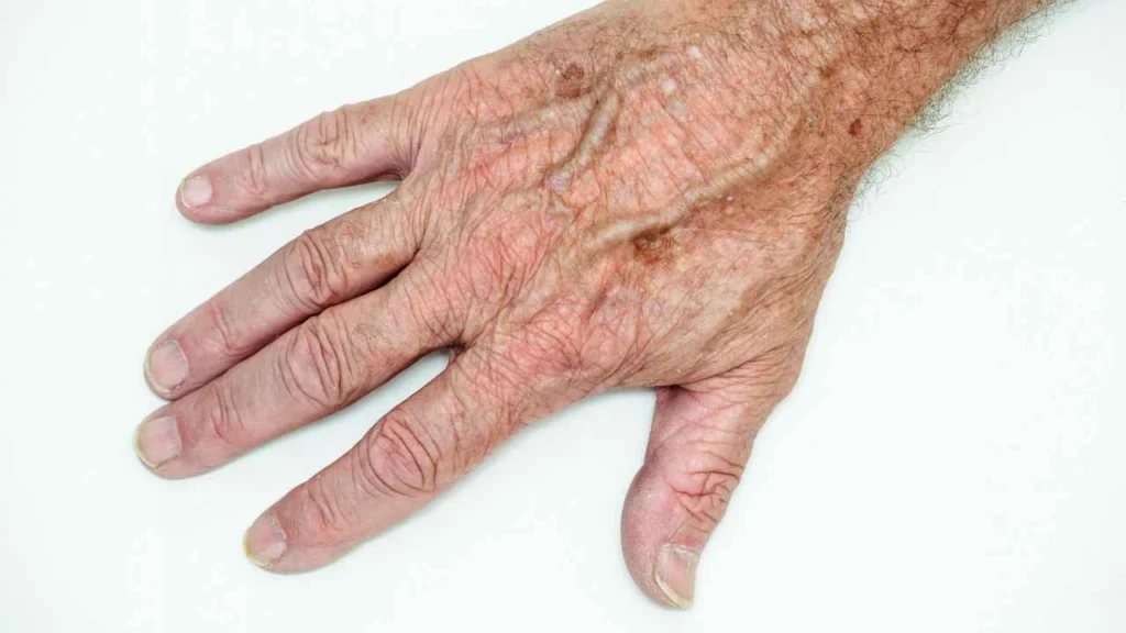 Male hand showing age spot Portsmouth