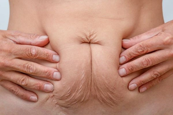 Image of a woman's stomach with loose skin - example of skin tightening Portsmouth options